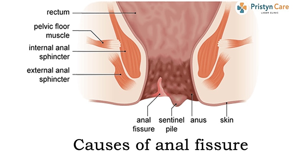 Anal fissure causes