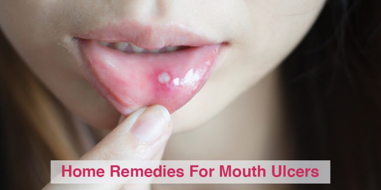 Home remedies for mouth ulcers