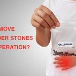 Remove gallstones without operation