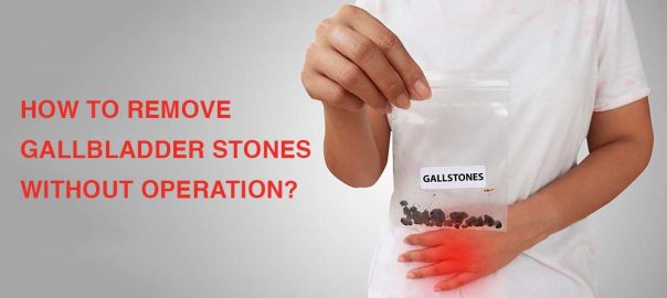 Gallbladder Stones Treatment Without Operation