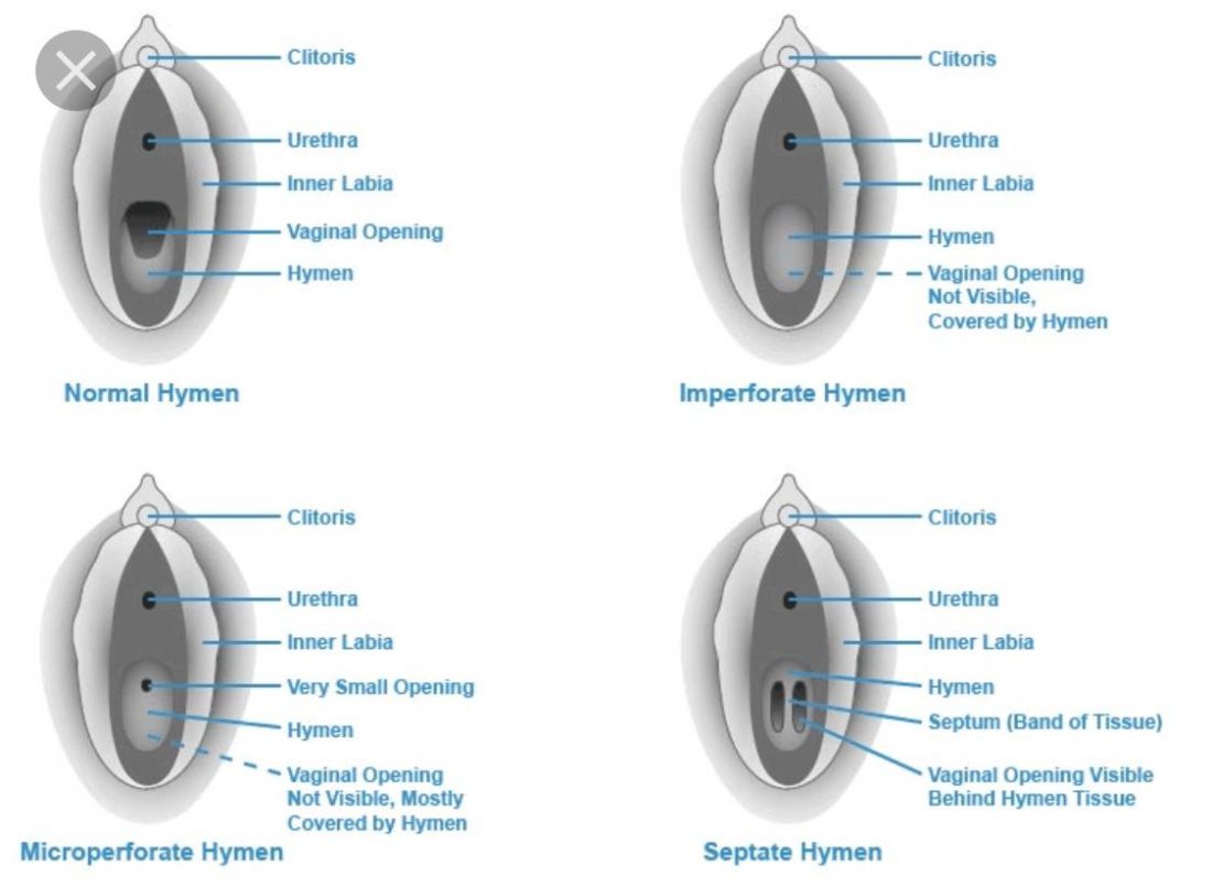 Type of hymen