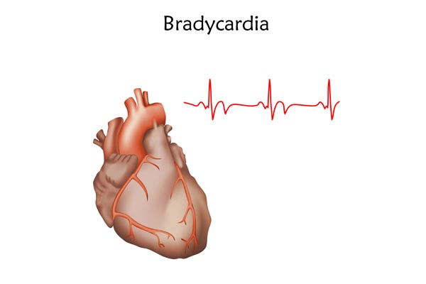 bradycardia