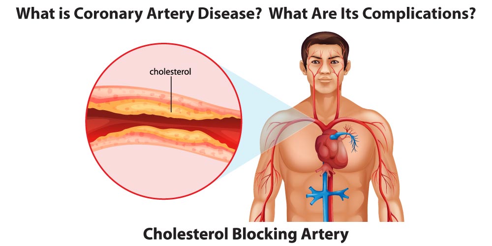 What Is Coronary Heart Disease? What Are Its Complications