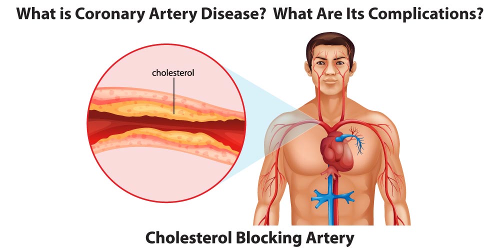 Coronary artery disease