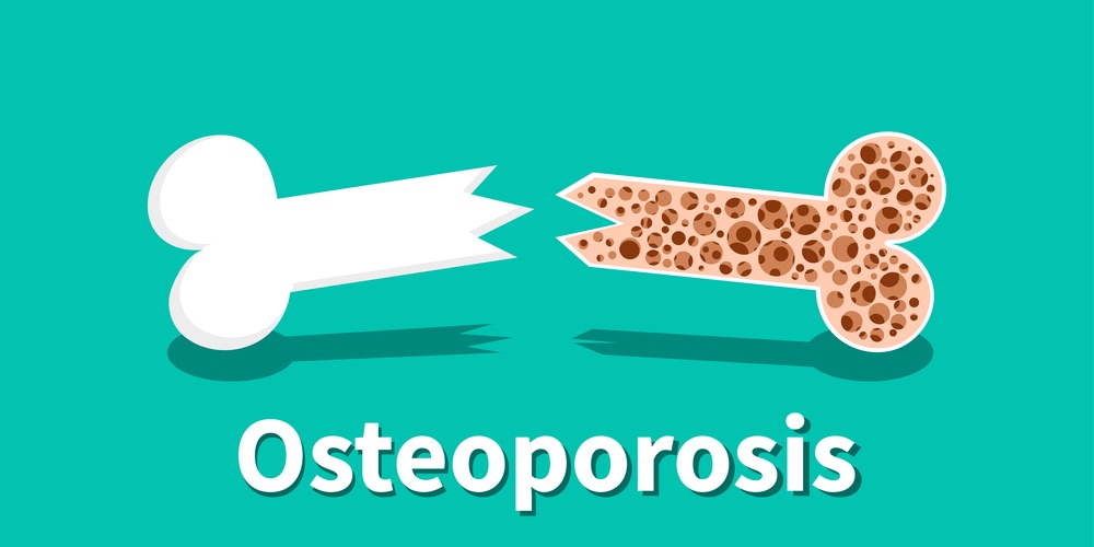 Osteoporosis 