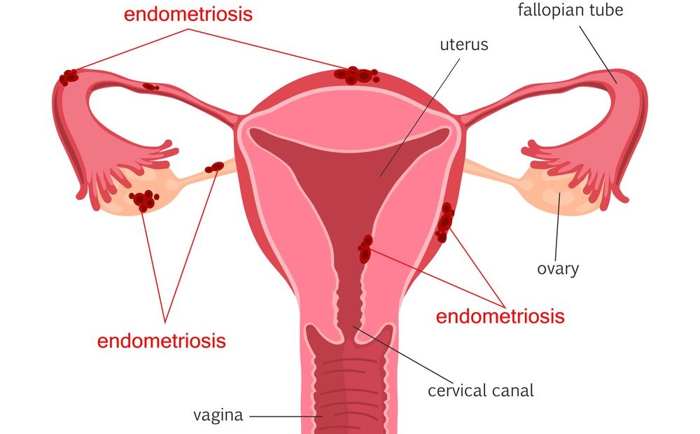 pregnancy with endometriosis