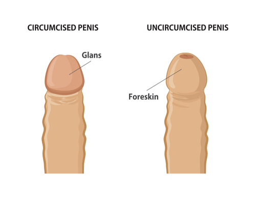 circumcised and uncircumcised penis 