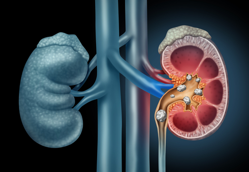 diagram showing kidney stones