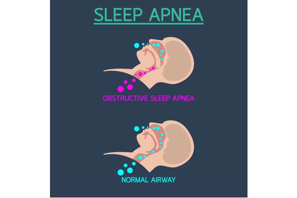 sleep apnea