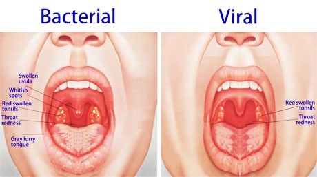 Bacterial and viral infections