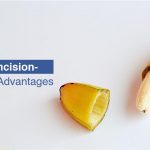 Laser Circumcision- Procedure and Advantages