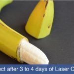 What to expect after 3 to 4 days of laser circumcision?