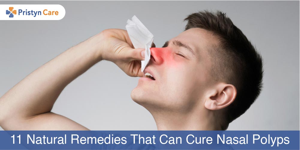 Home nose remedy polyps 20 Effective
