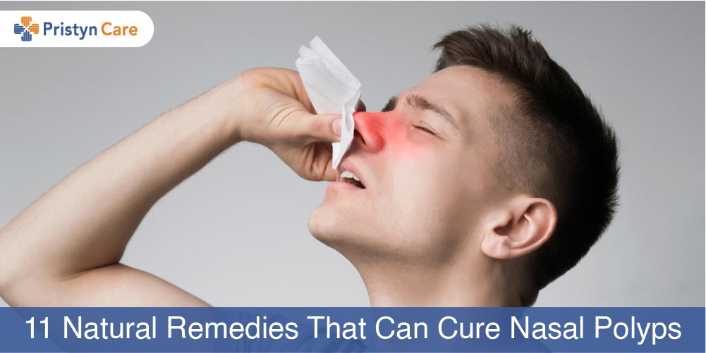 Polyps home remedy nose Nasal Polyps