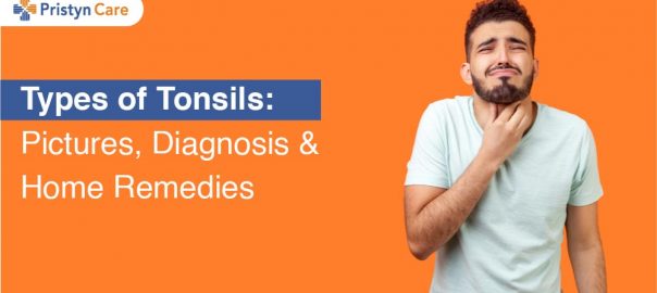 Types of Tonsils: Pictures, Diagnosis, and Home Remedies