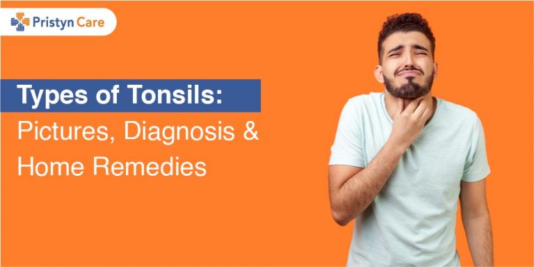 Cover image for types of tonsils