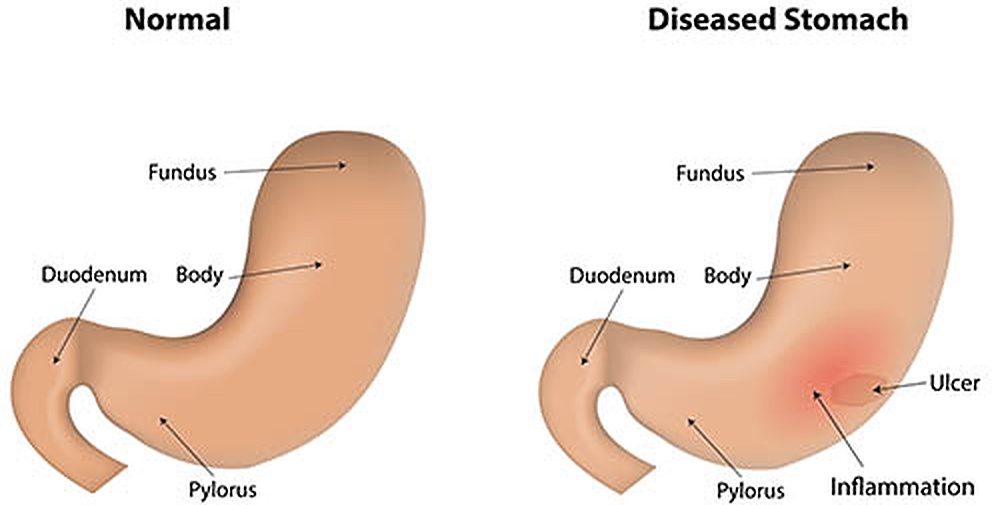 Crohns disease