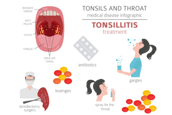 Treatment of tonsillitis in kids