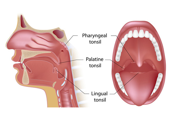 Types of tonsils