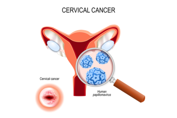 cervical cancer