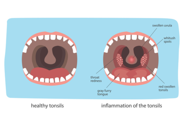 difference between inflamed and normal tonsils