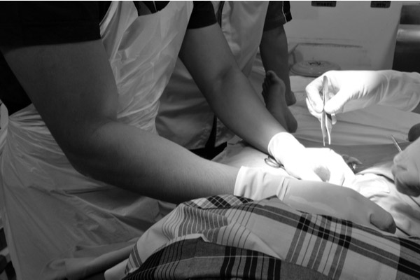 traditional procedure of circumcision