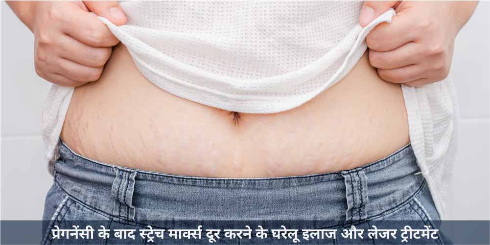 प्रेगनेंसी स्ट्रेच मार्क्स दूर करने के घरेलू इलाज और लेजर ट्रीटमेंट