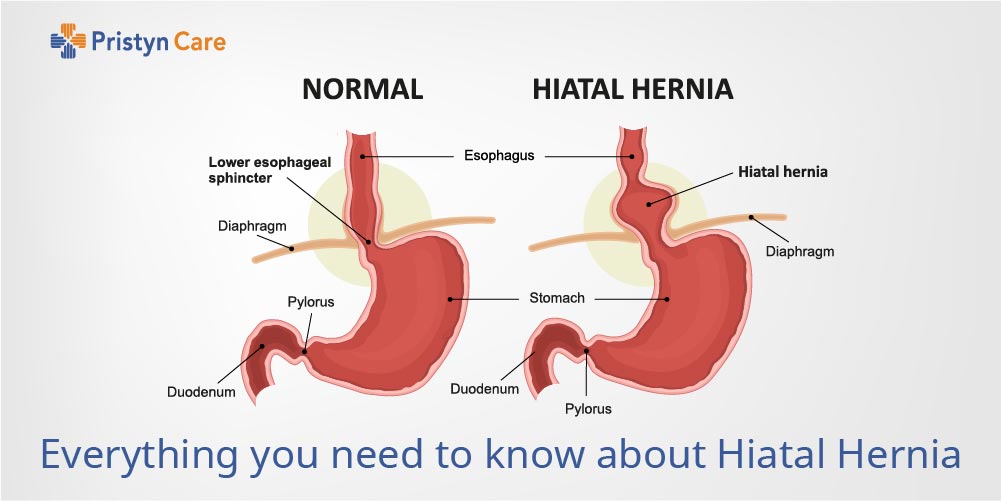Everything About hiatal hernia