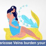 Can Varicose Veins burden my Pregnancy? 