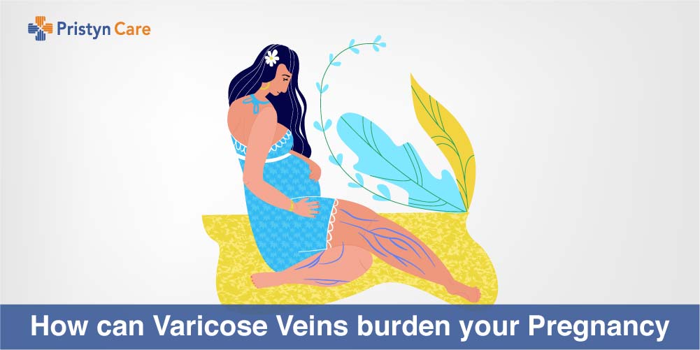 Can Varicose Veins burden my Pregnancy? 