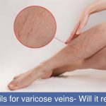Essential oils for Varicose Veins