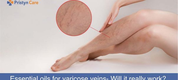 Essential oils for Varicose Veins- Will it really work?