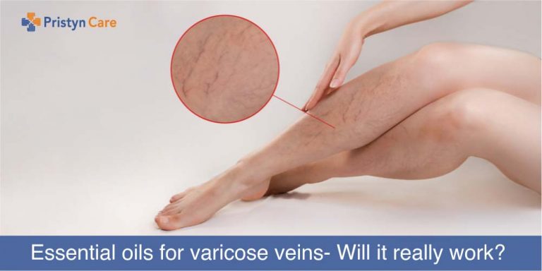 Essential oils for Varicose Veins