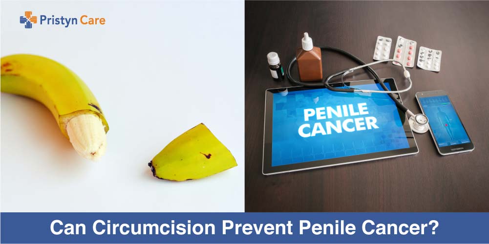 Can Circumcision prevent penile cancer