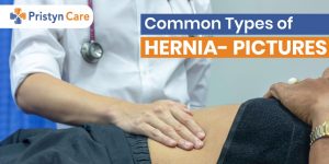 Common types of Hernia Pictures