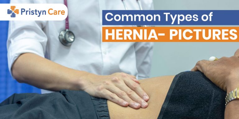 Common Types of Hernia in Men | Know Completely