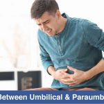 Cover image for difference between umbilical and paraumbilical hernia