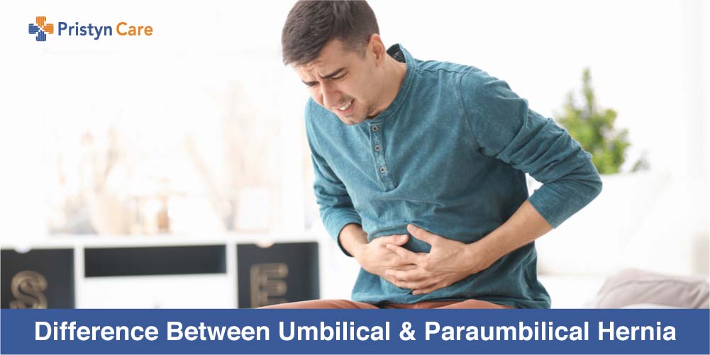 Cover image for difference between umbilical and paraumbilical hernia