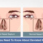 Cover image for everything to know about deviated septum
