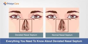 Cover image for everything to know about deviated septum