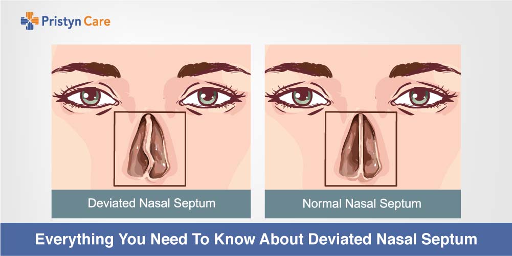 Cover image for everything to know about deviated septum