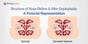 Cover image for nose before and after septoplasty
