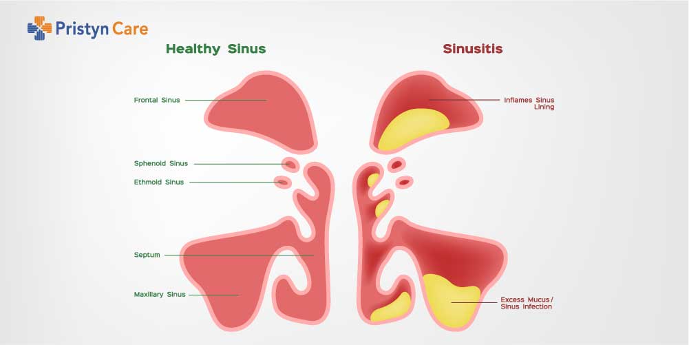 Difference between healthy and infected sinuses