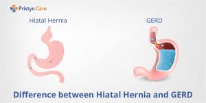 Difference between hiatal hernia and Gerd