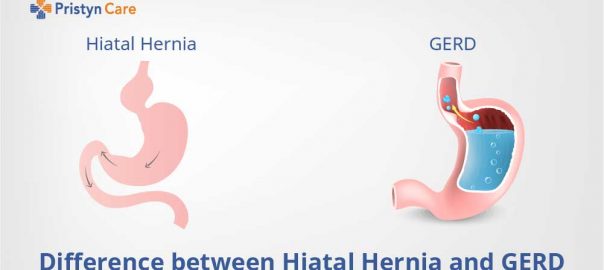 Difference between Hiatal Hernia and GERD