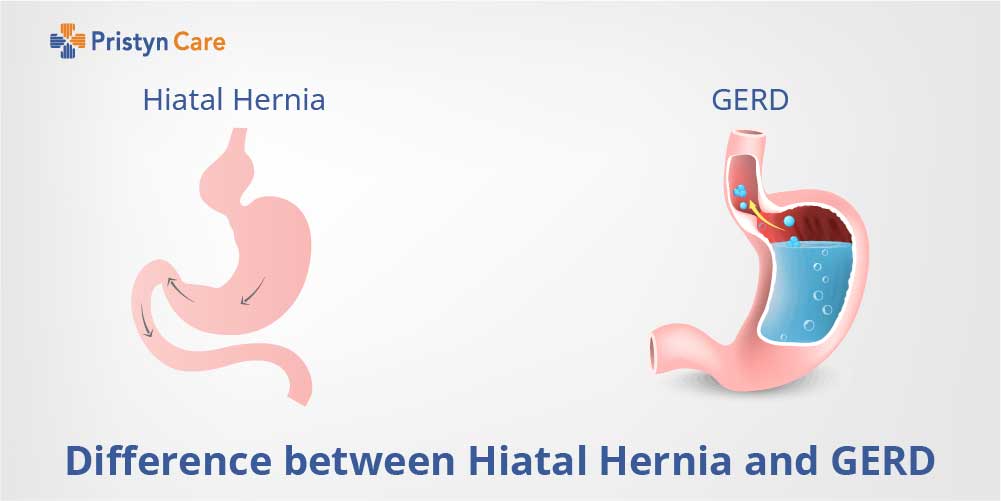 Difference between hiatal hernia and Gerd