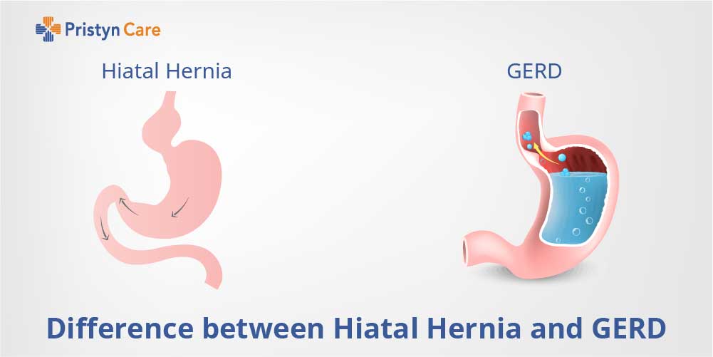 Difference Between Hiatal Hernia And GERD Hiatal Hernia Vs GERD