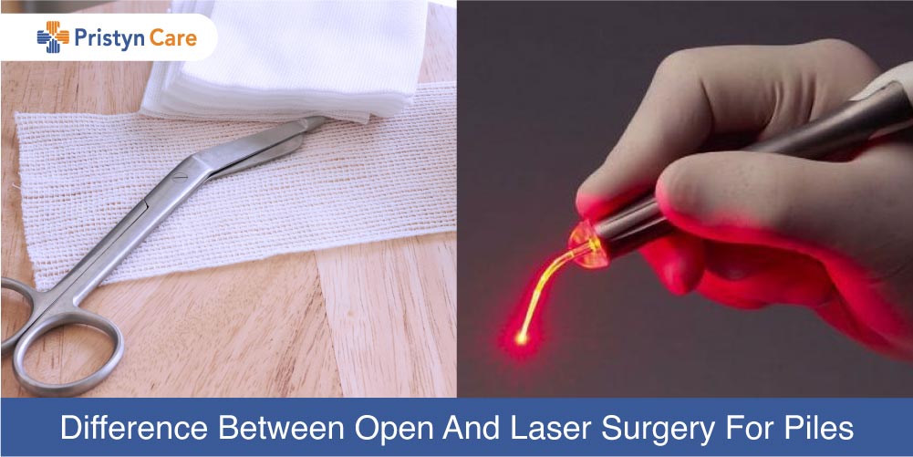 Difference between open and laser surygery for piles