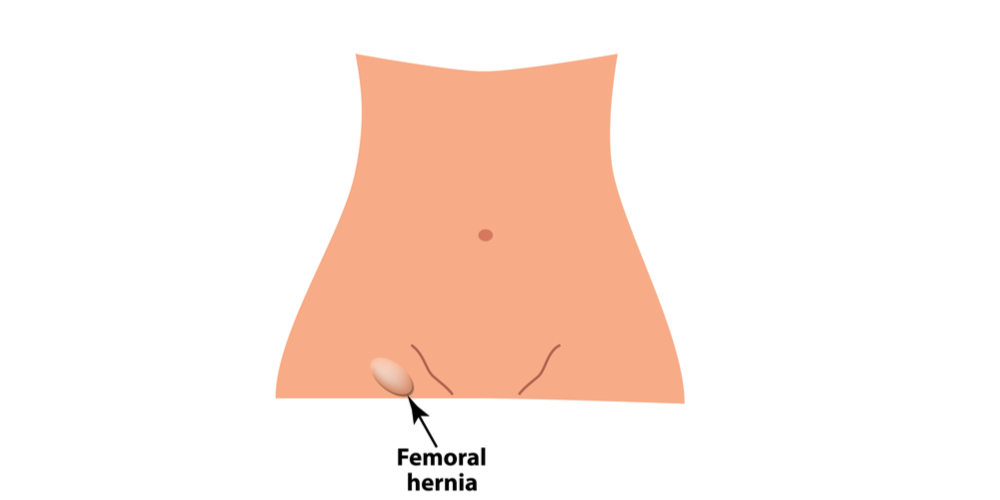 Femoral Hernia