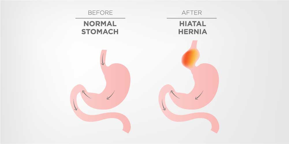 Normal stomach vs hiatal hernia stomach